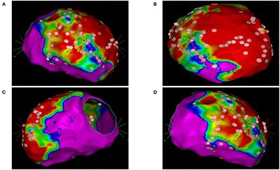 Cardiopulmonary Support During Catheter Ablation of Ventricular Arrhythmias With Hemodynamic Instability: The Role of Inducibility